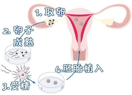 靠谱志愿者供卵咨询